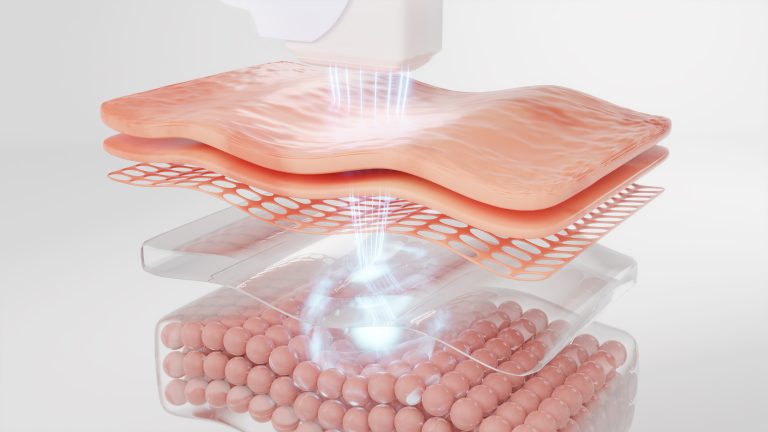 Ultherapy for Décolleté (4th Fl)