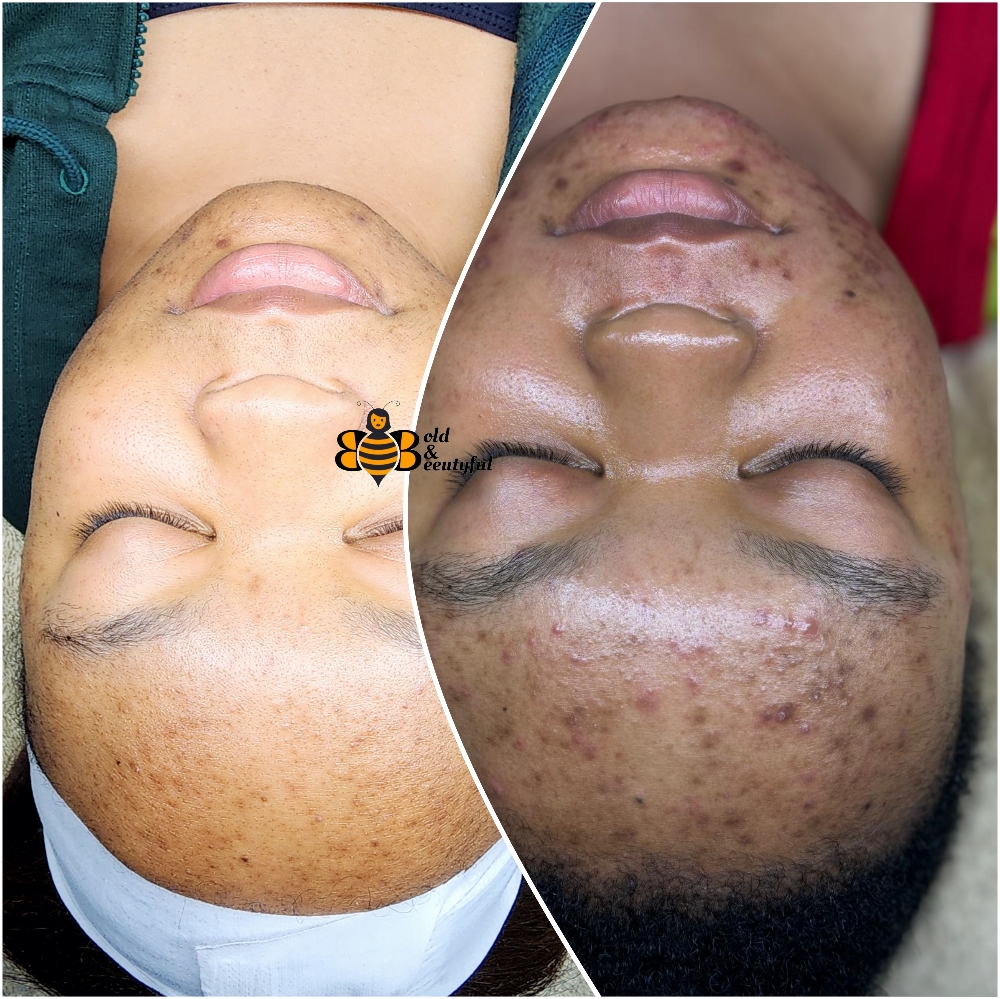 6 Acne Treatment Facial