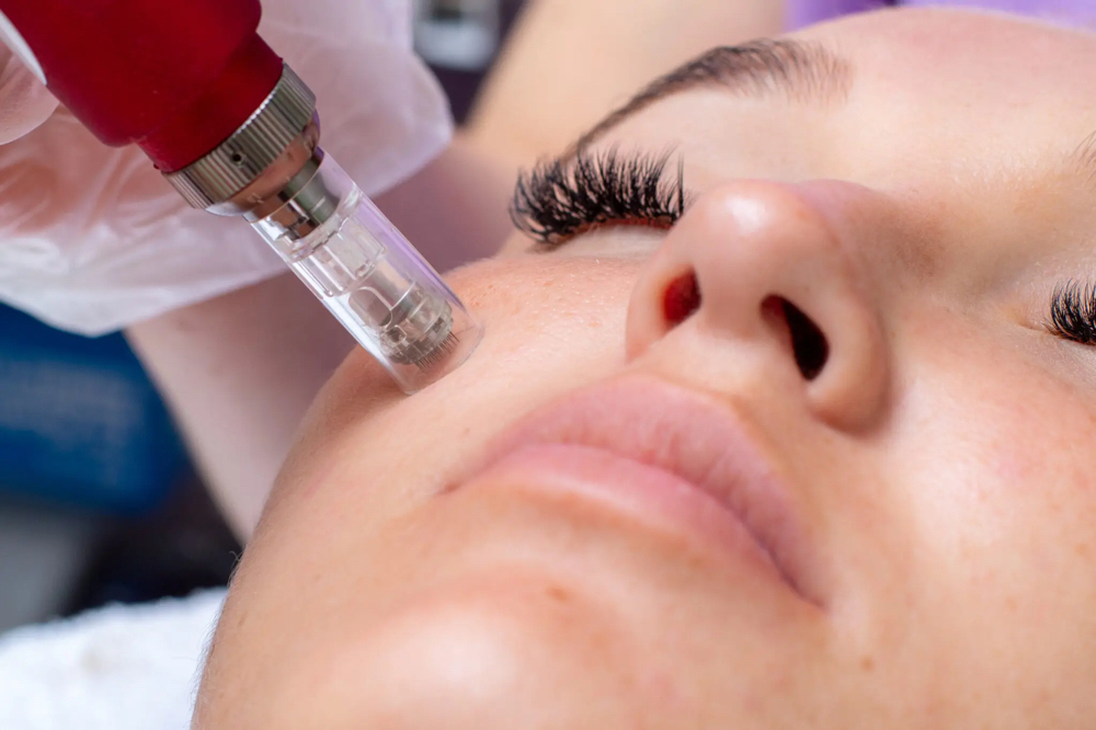 Microneedling Includes 3 Treatments