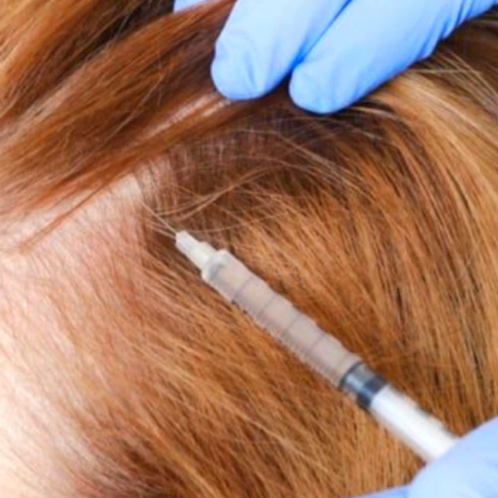 Plasma Capilar at Vanessa Rivera hair wellness in Frisco, TX
