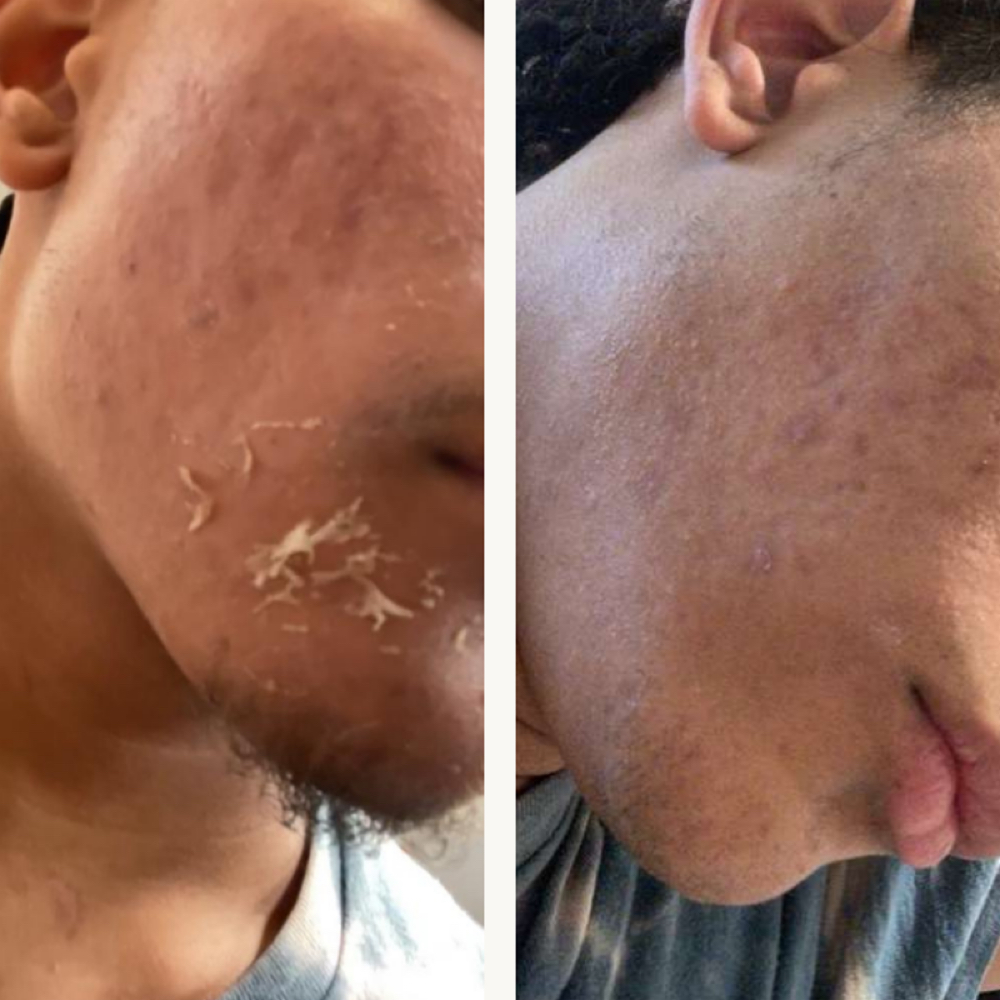 Chemical Peel / Acne/ at Nenusk Aesthetics in Long Island City, NY