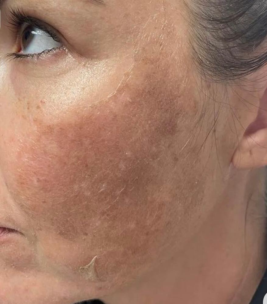 TCA PEEL FACIAL at Farmhouse spa in Oklahoma City, OK