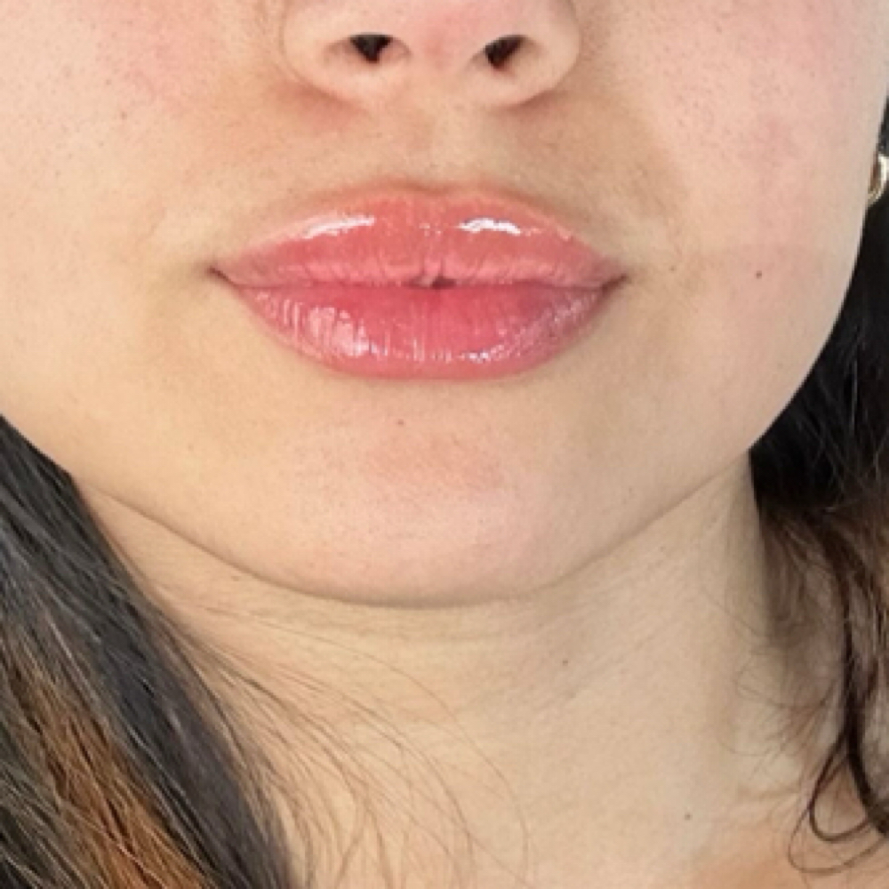 Lip Flip at Kimspa&beauty in Dallas, TX