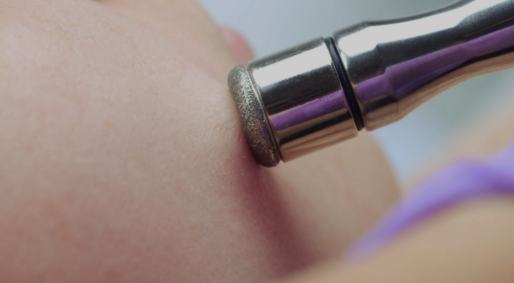 Skin Treatment (Microdermabrasion)