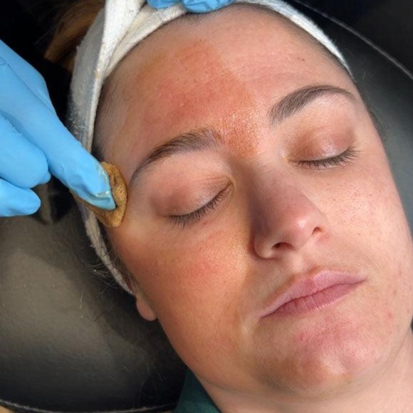 Consultation VI Peel at Angelic Medi Spa in Lynbrook, NY