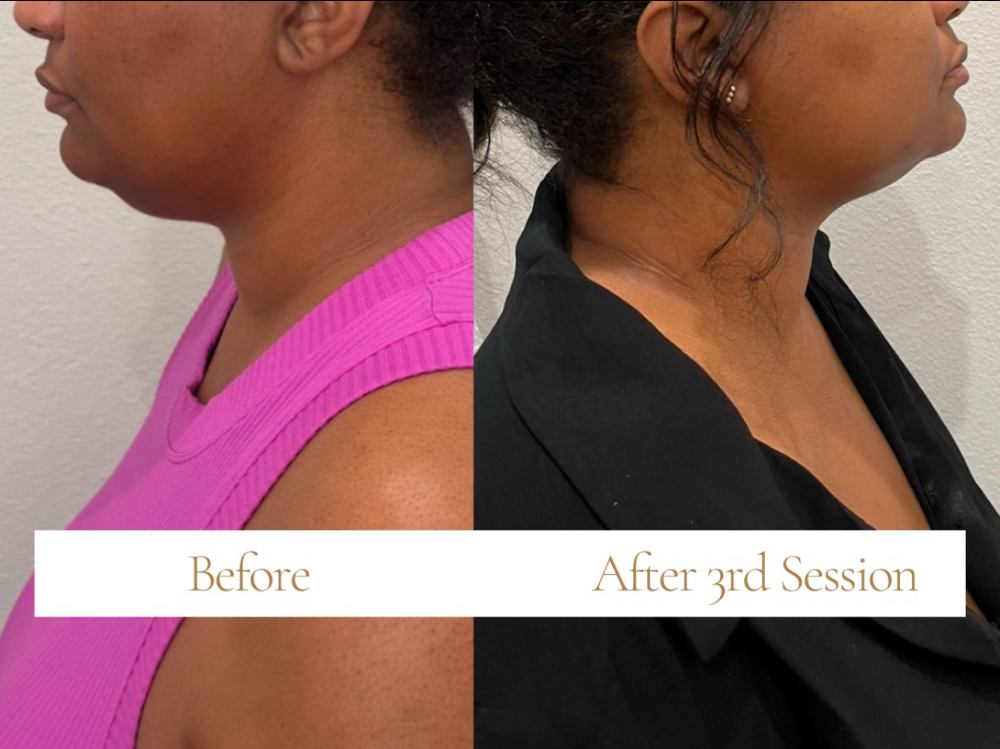 Double  Chin Treatment at Blossom Vanity Spa in Missouri City, TX