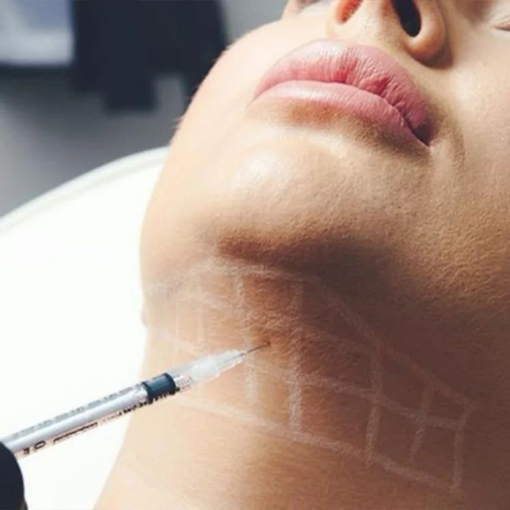 PCDC- Double Chin/Papada at Lumé Aesthetics in Pharr, TX