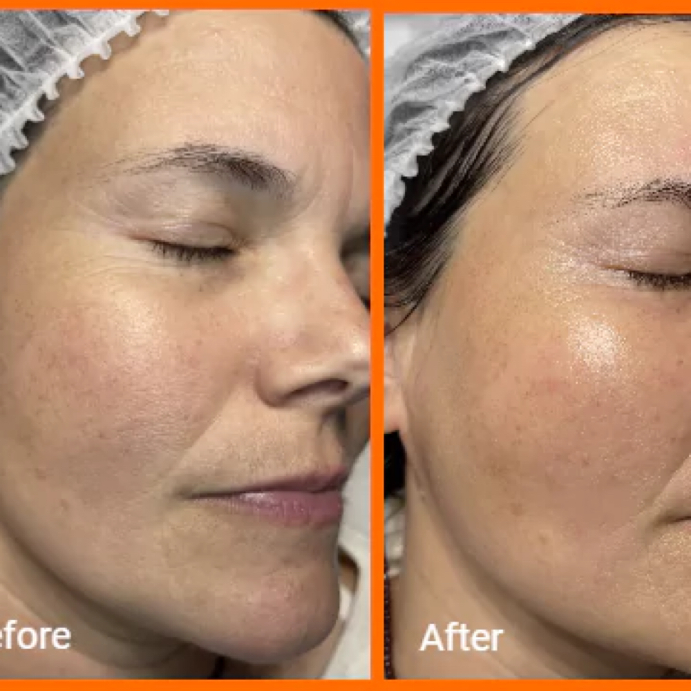 Glass Skin Treatment at Elite Choice Skin in Baldwin, NY