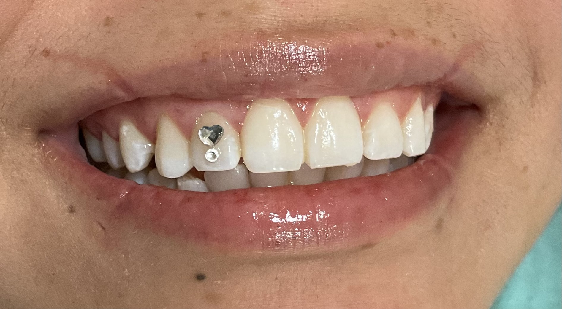 2 Tooth Gems