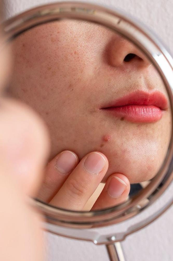 Acne Treatment Facial at Skin and Body by Julia Donis in Burbank, CA