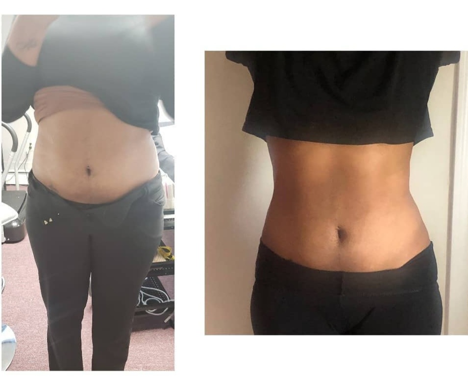 Lipo Cavitation 6 Sessions