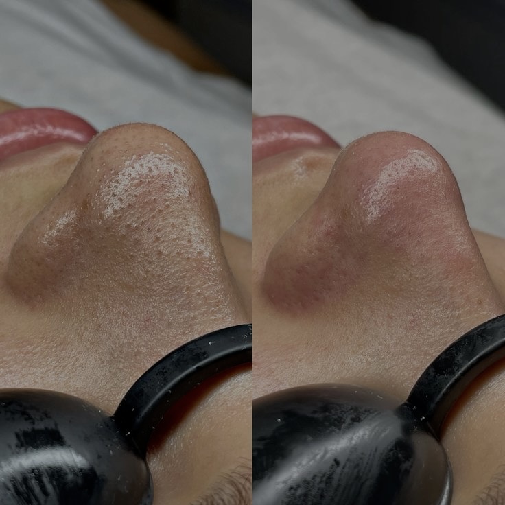 Acne Facial