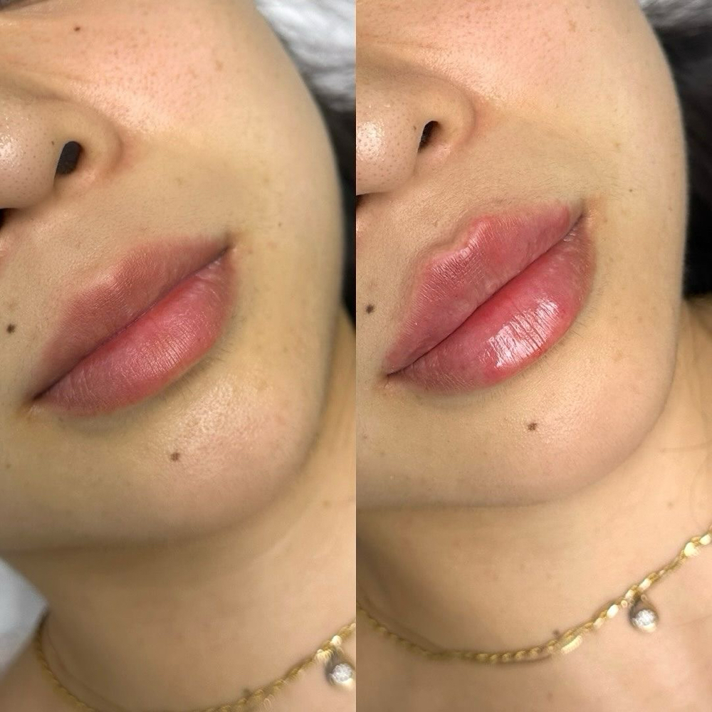 Full Syringe Of Lip Filler at Lilli Aesthetics LLC in Mansfield, TX