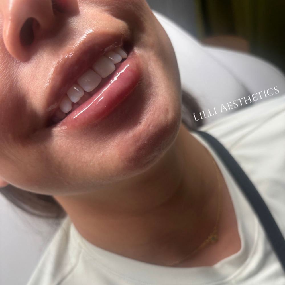 Lip Filler at Lilli Aesthetics LLC in Mansfield, TX
