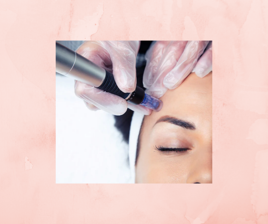 Microneedling