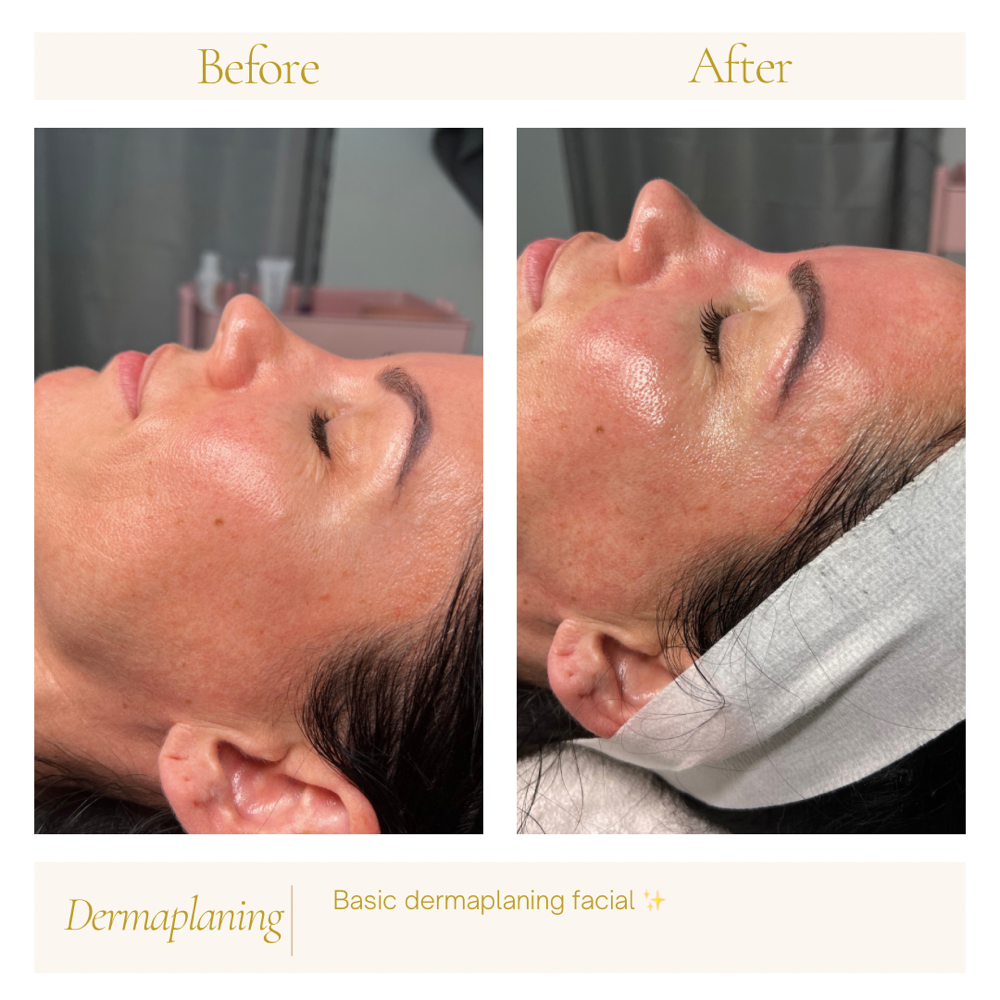 Basic Dermaplaning