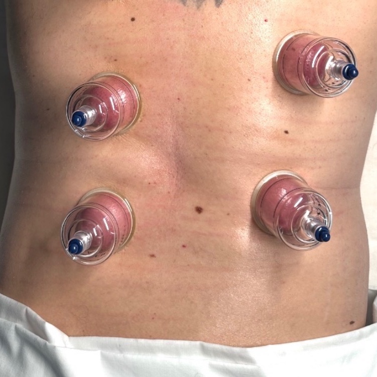 Cupping Therapy at T&N Skin Med Spa Inc in Abington, PA