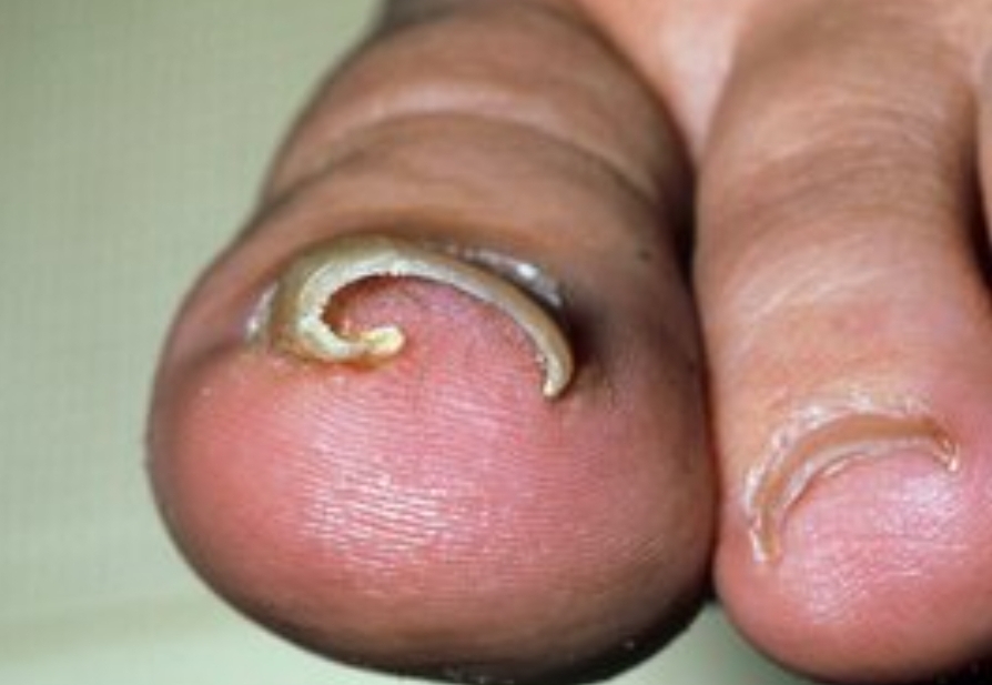 Ingrown Removal