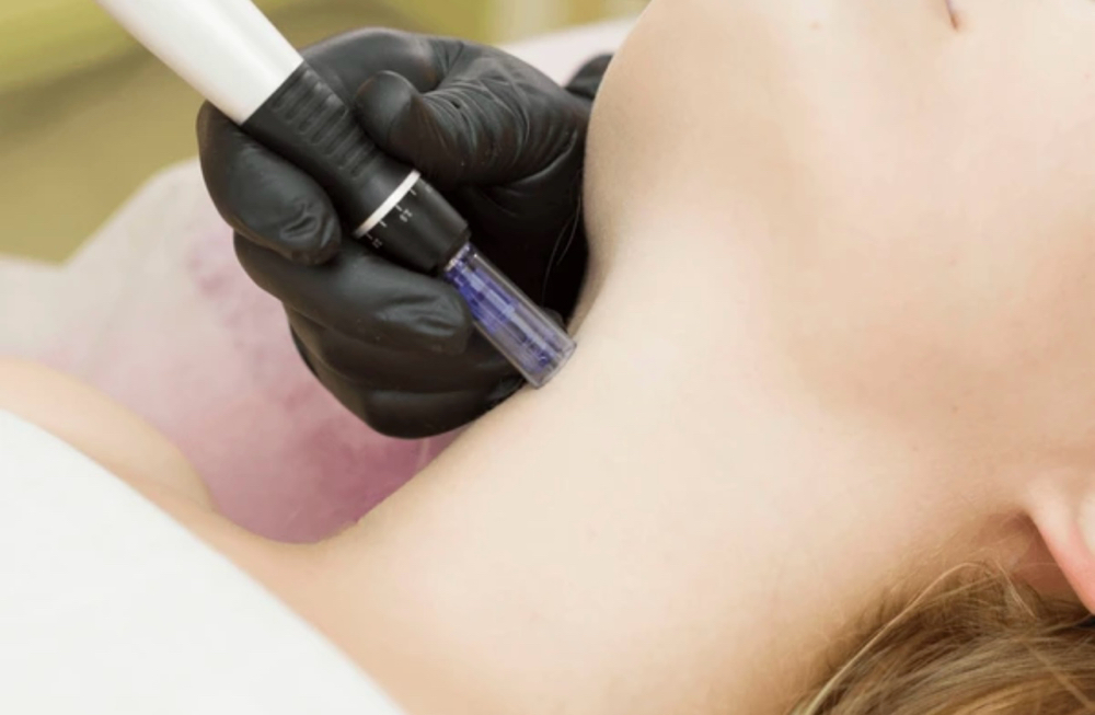 Microneedling Neck