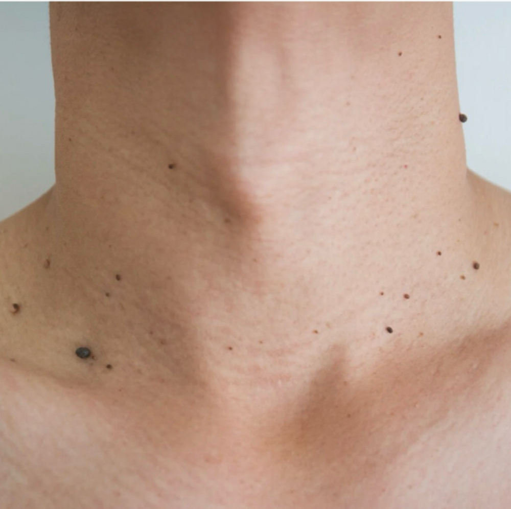 Skin Tag Removal at Joy to Beauty in Jupiter, FL