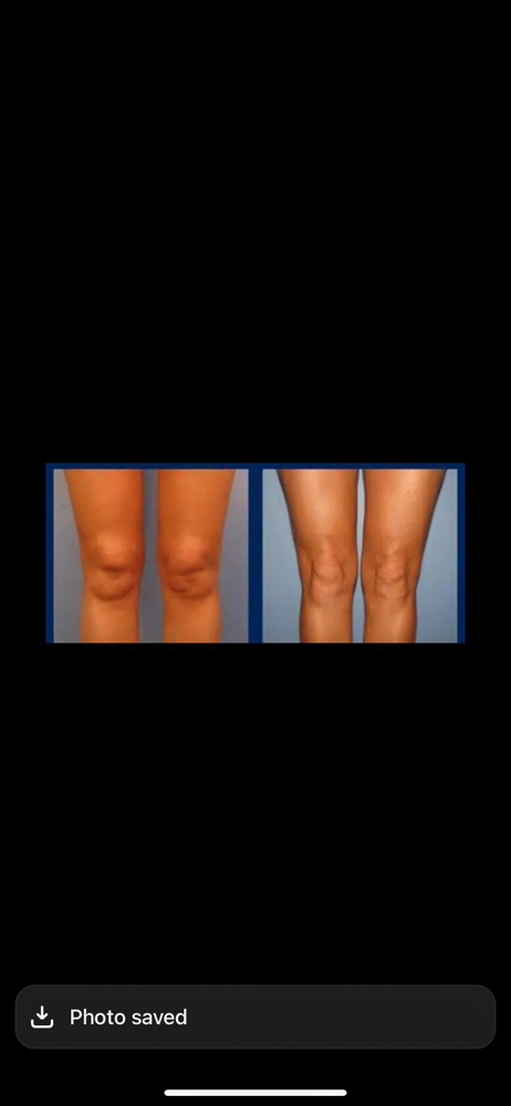 Knee Injections