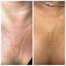 Chest Wrinkle Bio-Reju