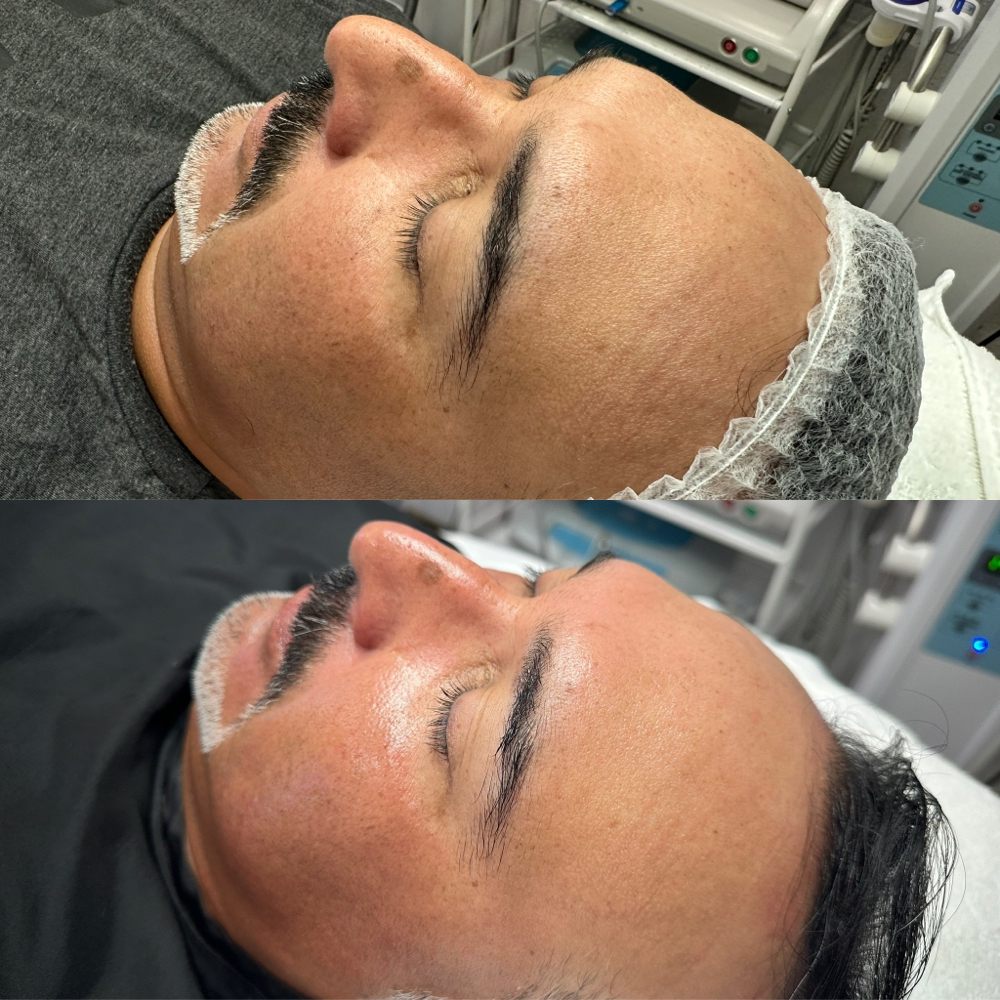CO2 Carboxy + Microdermoabrasion