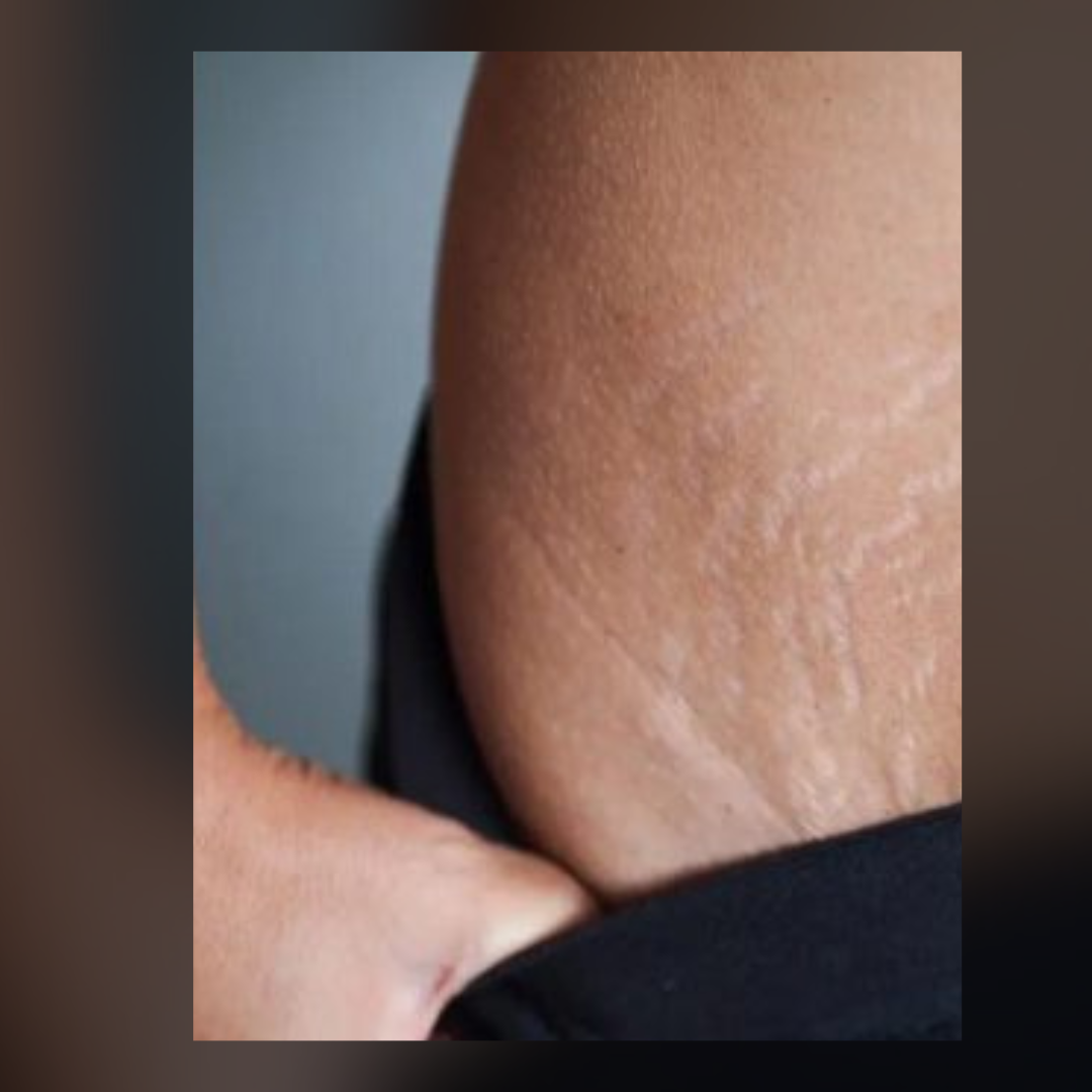 Stretchmark Camouflage