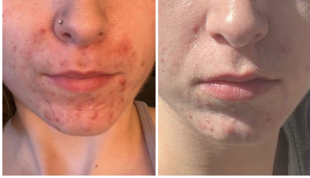 Teen Glow Facial