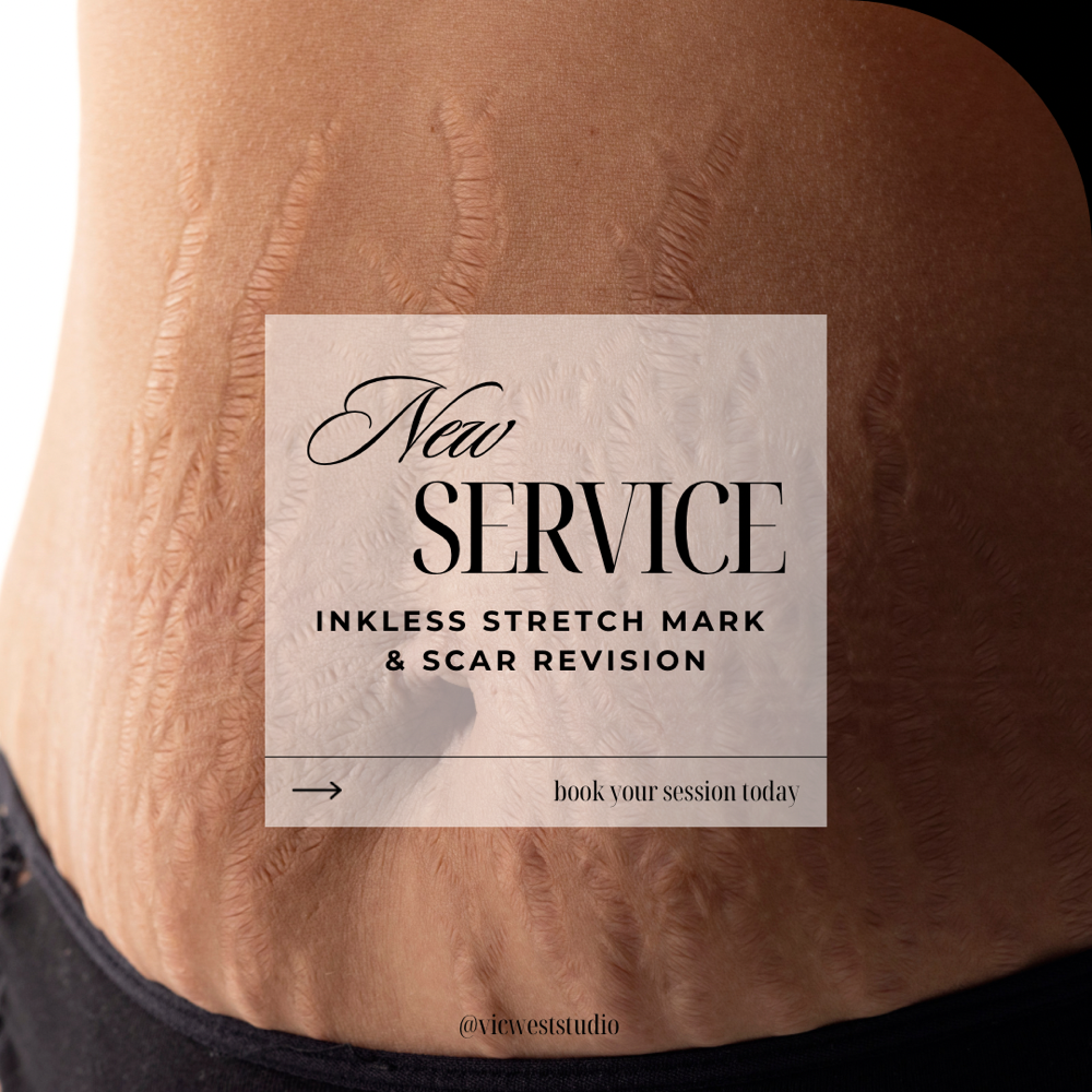 Scar/Stretch Mark Revision