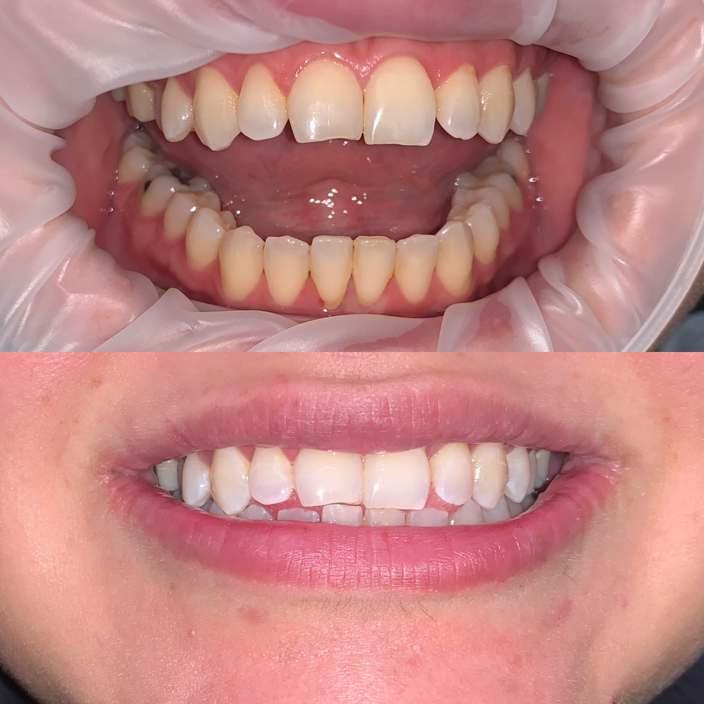 Teeth Whitening at Golden Hour Tan in San Antonio, TX