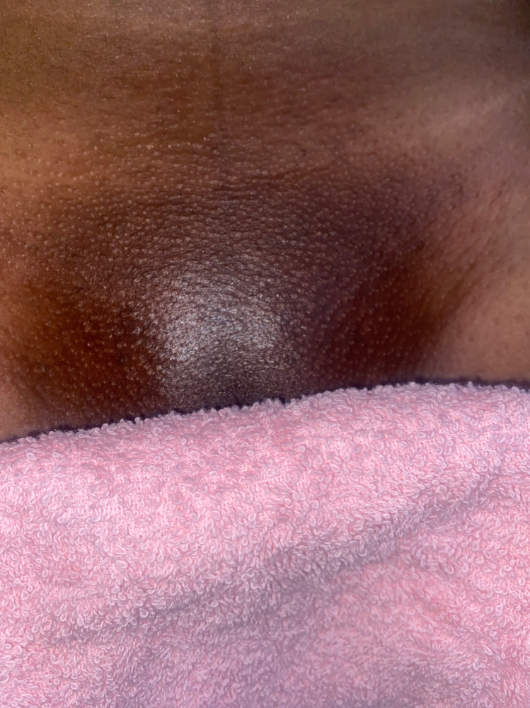 Ingrown Hair Extractions