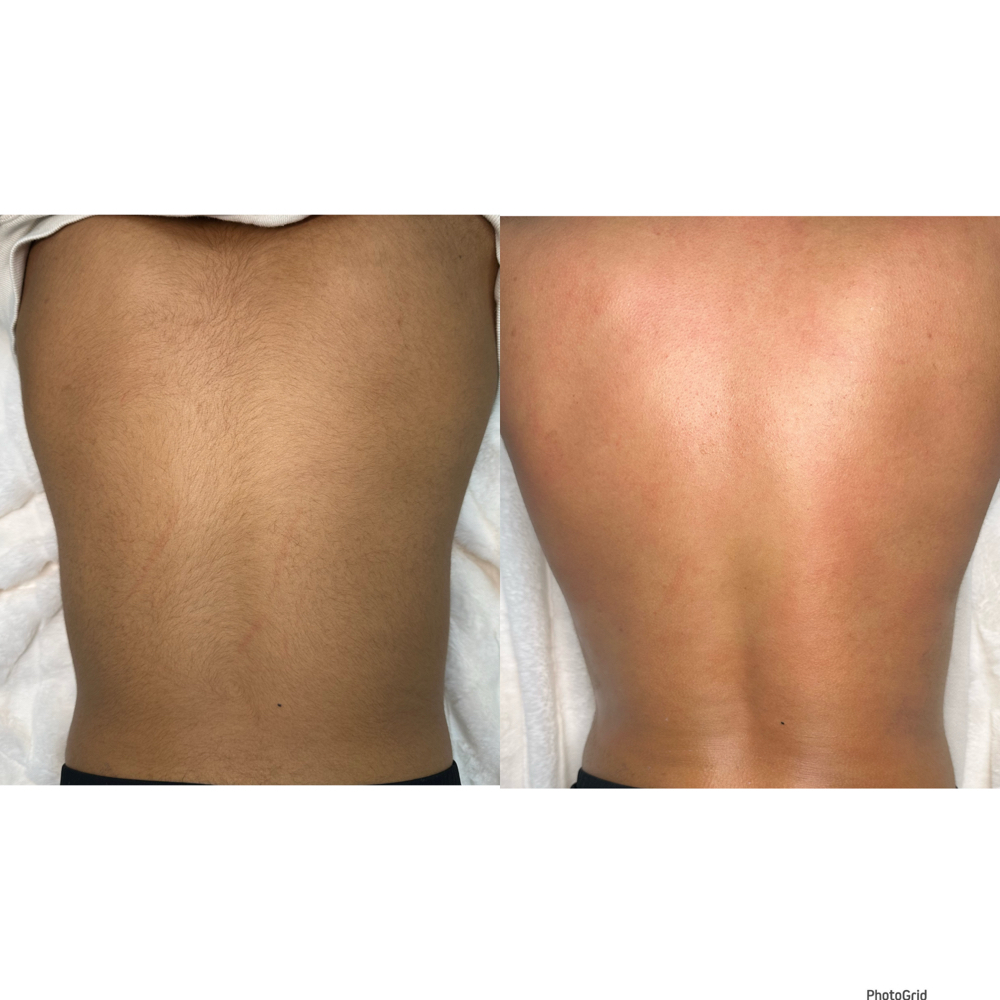 Back Wax Hair Removal