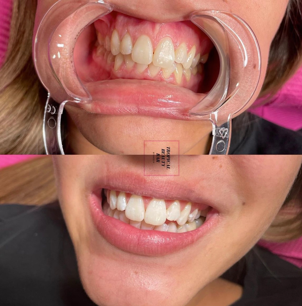 35 minute Teeth whitening