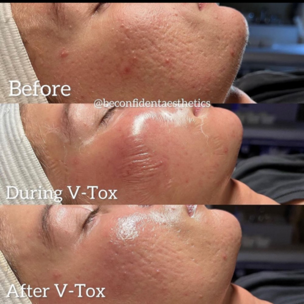 Add On Dermaplane To V-Tox Facial at Skin By Carly in LaFayette, GA