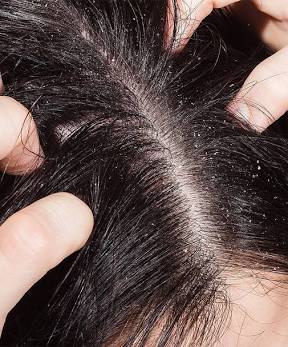 Scalp Treatment