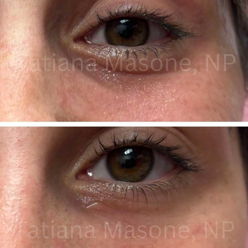 Undereye Filler