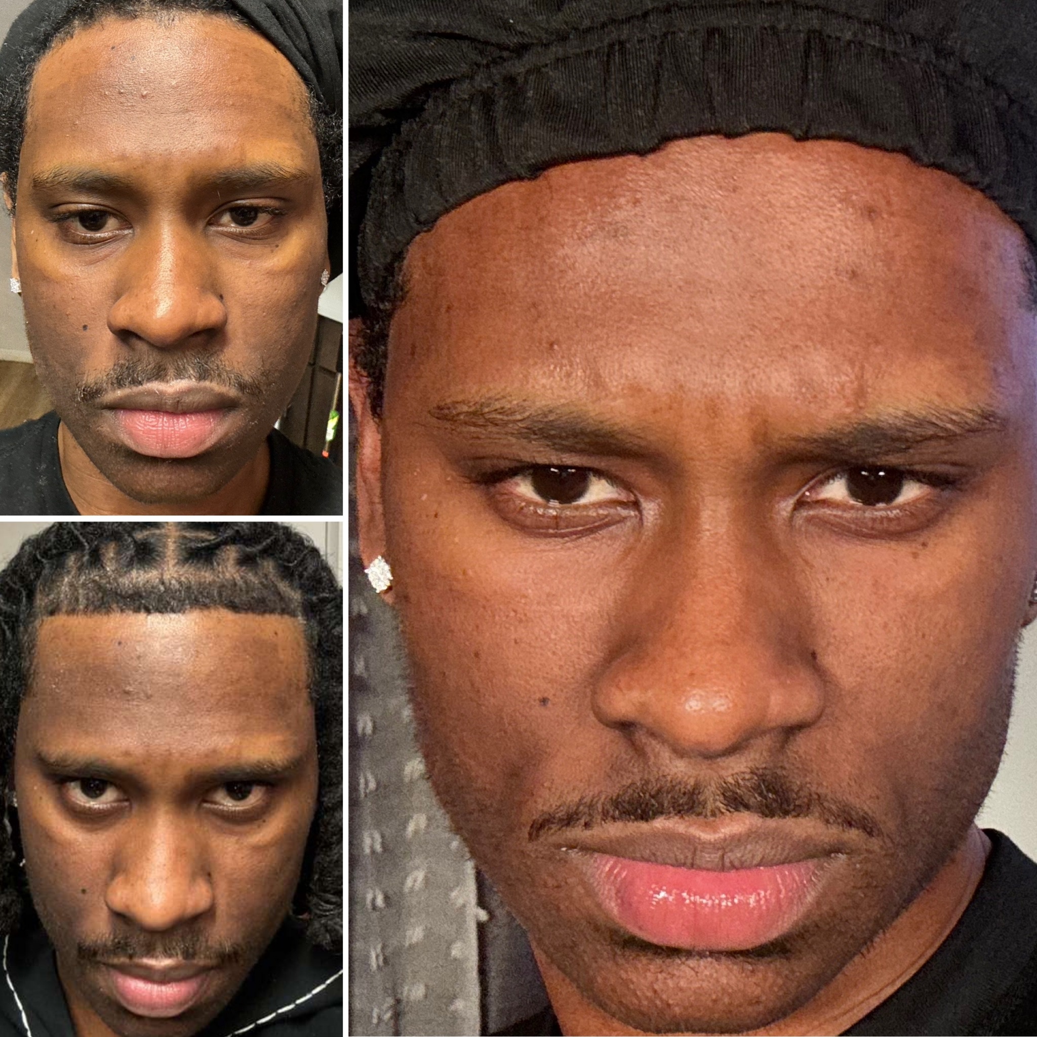 PRP Under-eye / Skin Rejuvenation at The Rejuvenation Suite Med Spa in New Rochelle, NY