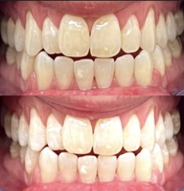 Classic Smile - Teeth Whitening