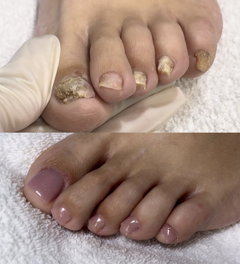 Toe BBL(Severe Fungus)