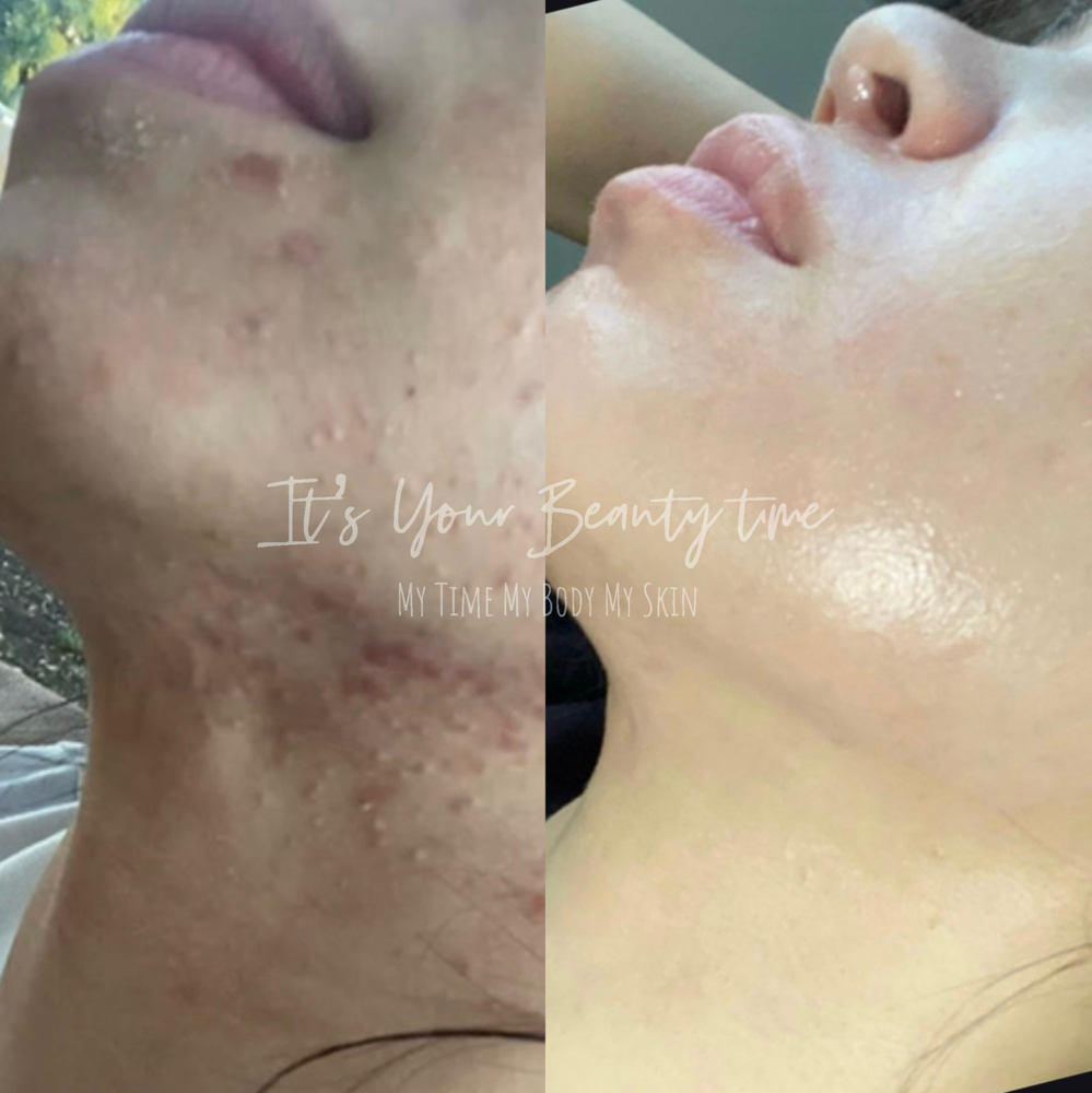 ACNE/LED FACIAL TREATMENT