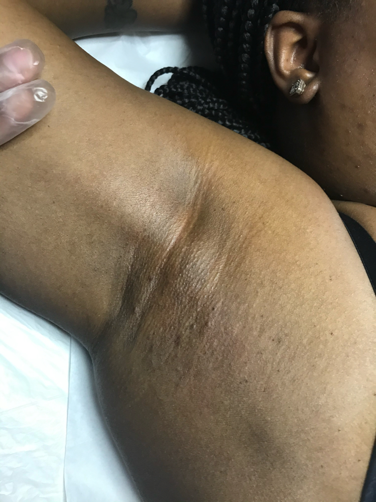 Underarms at WYN SKIN & BROWS in Dallas, TX