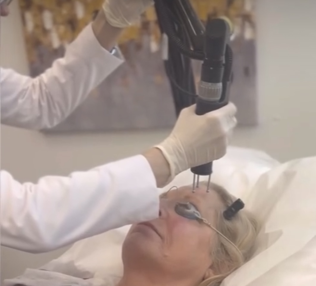 Dermablate Erbium LaserResurfacing at Le Reve in Fort worth, TX