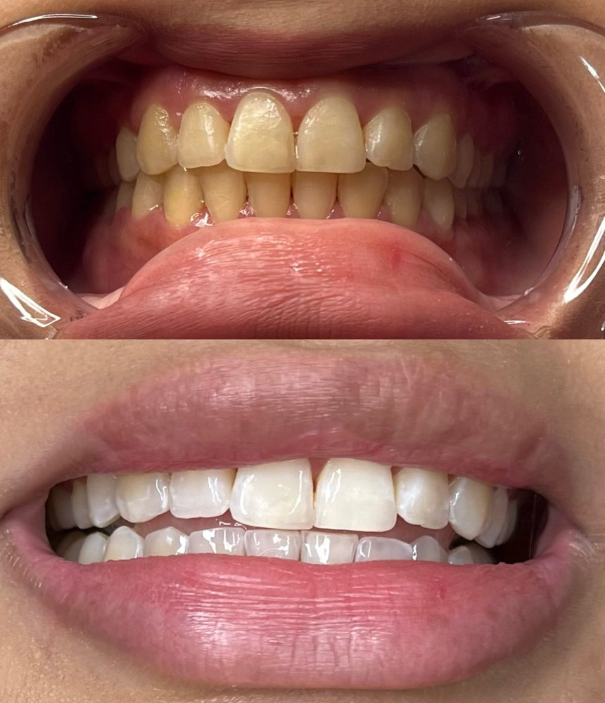 Pearl Teeth Whitening