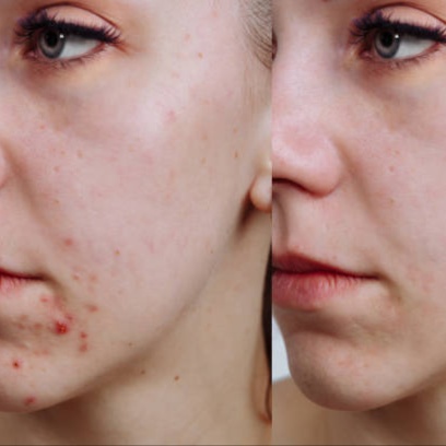 Acne Treatment at Bliss Beauty Bar in Houston, TX