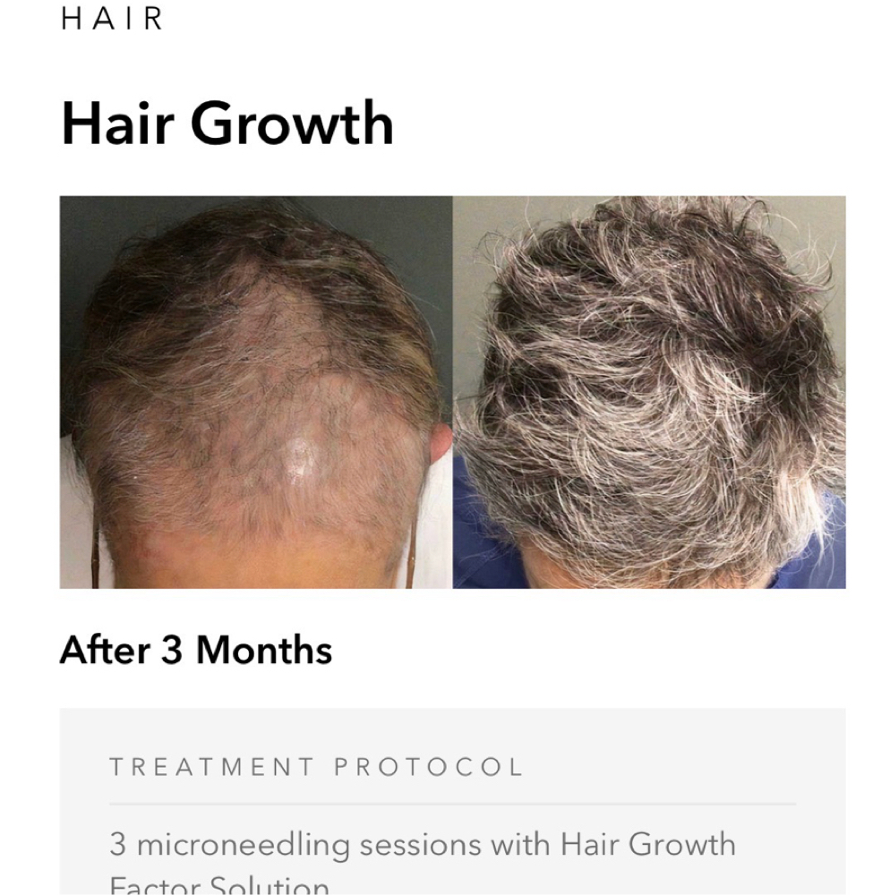 Hair Microneedle Exosomes at L A BEAUTY STUDIO in Lakeway, TX