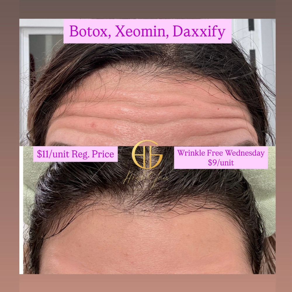 Botox / Xeomin/ Daxxify