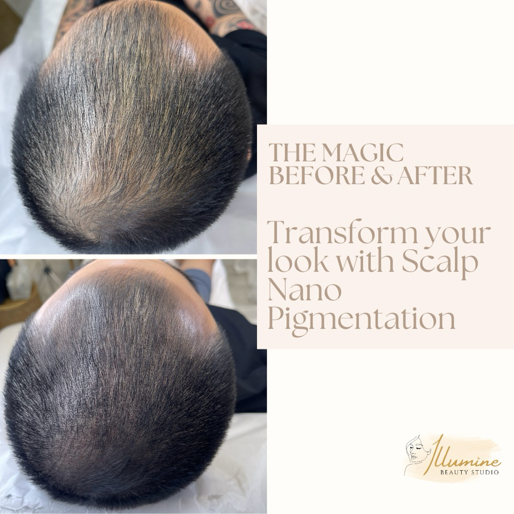 Scalp Nanopigmentation