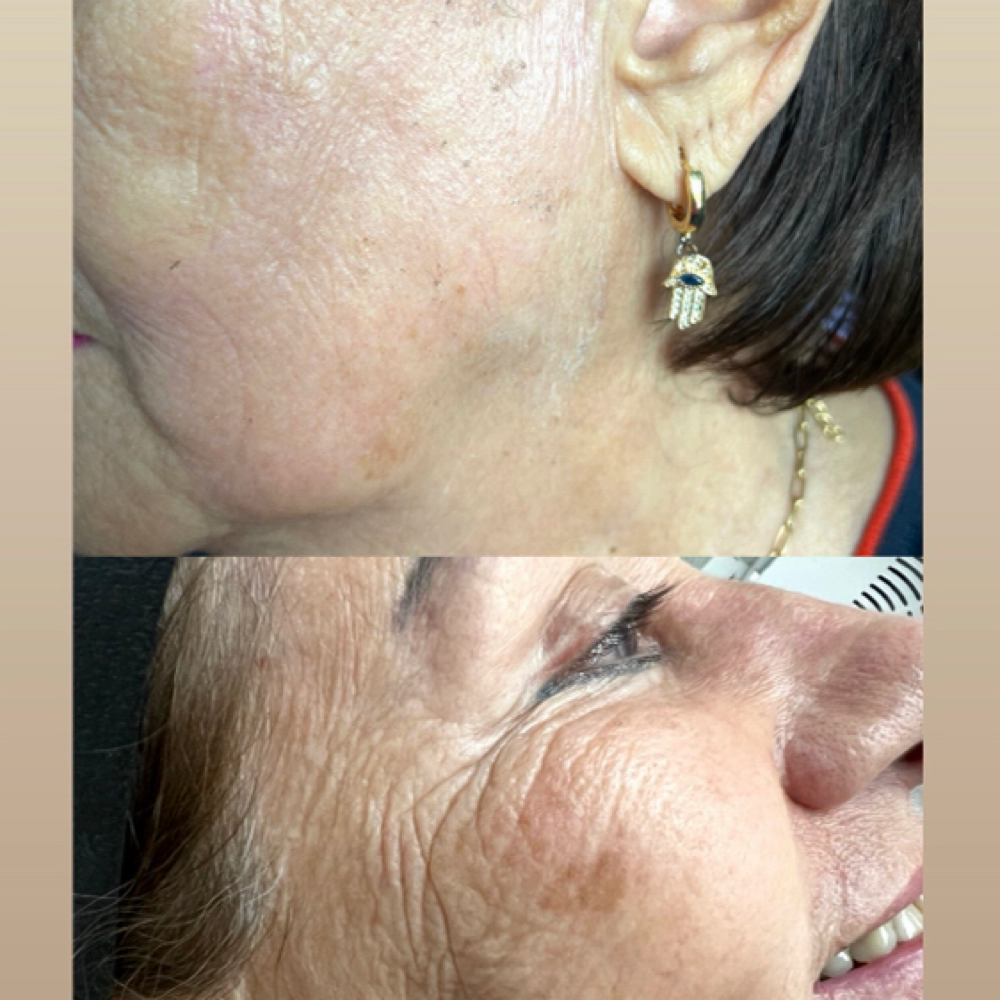 Fibroblast at Bella Vivi in Orlando, FL