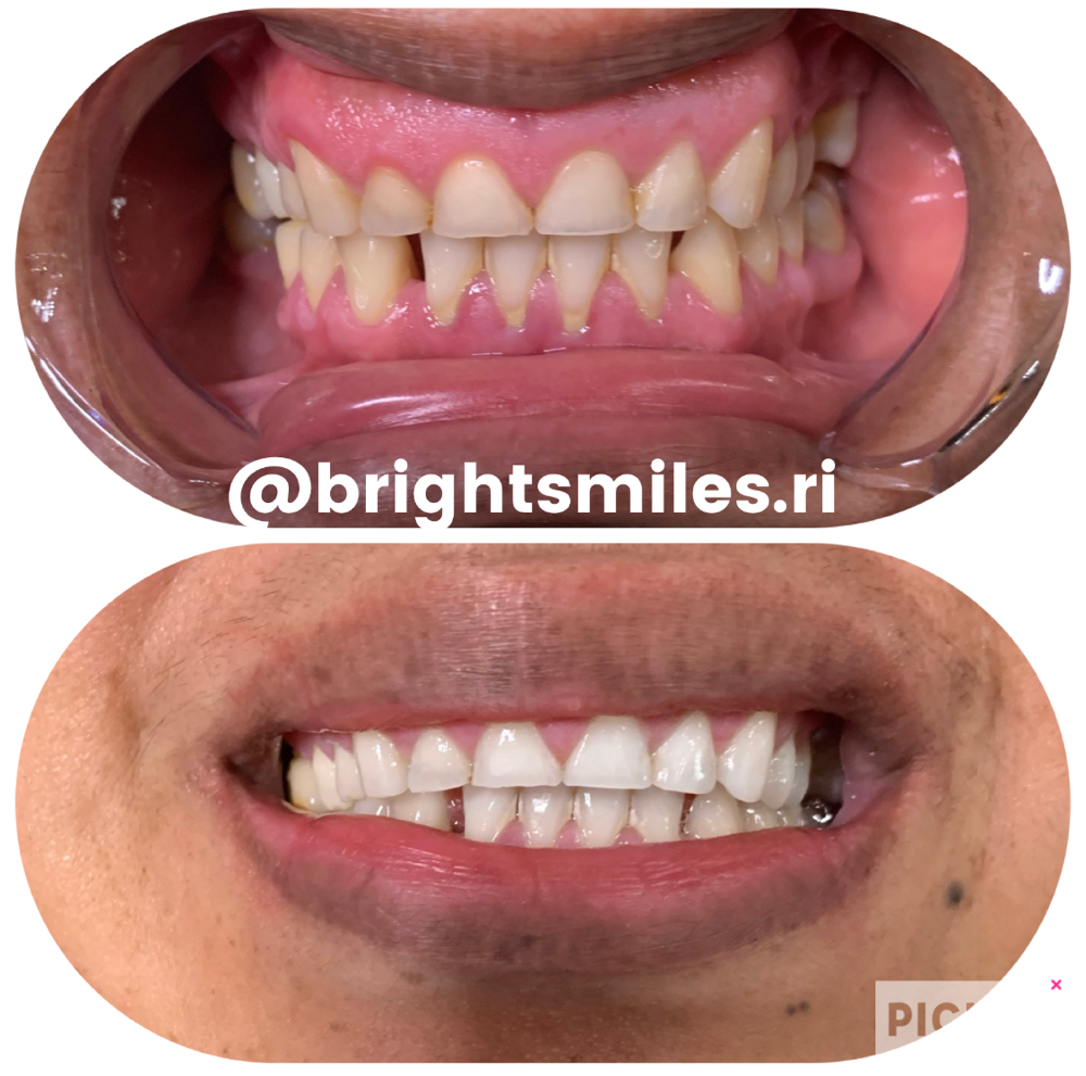 Teeth Whitening Touch Up